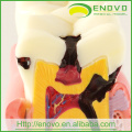 Modèle de dents pathologiques dentaires EN-M2 de 6Ttimes Caries Comparation
